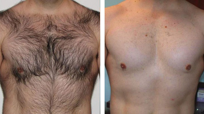 IPL therapy can be used effectively to remove body hair