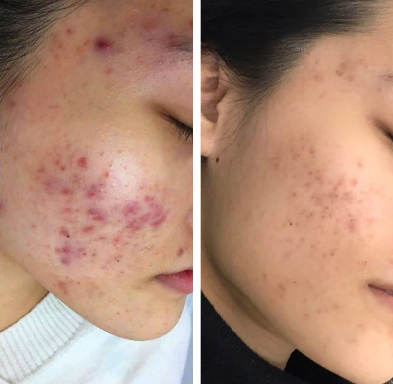 IPL therapy can be used effectively to target acne